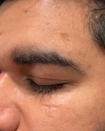 Microneedling — before