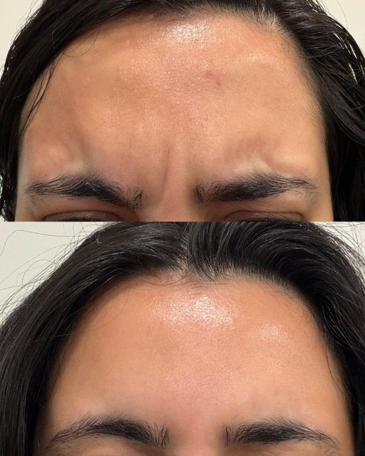 Wrinkle Relaxers — before